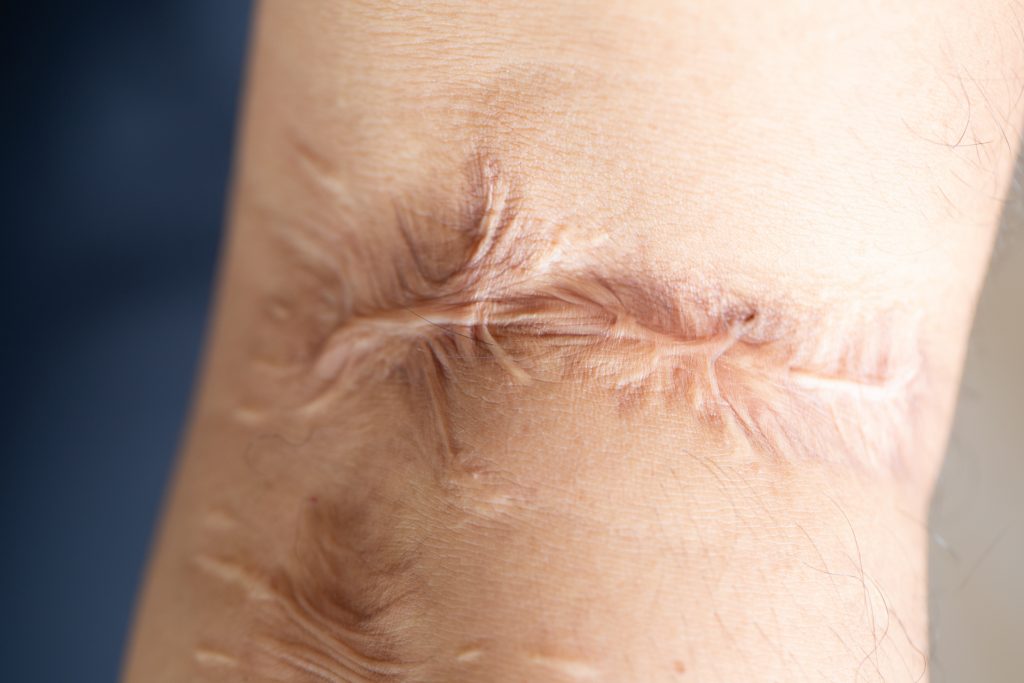 Scar on skin arm.