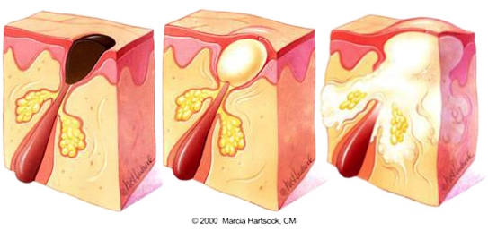 Comedones Pustule MH CMI