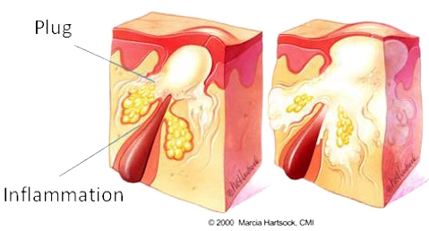 Papules Pustules MH CMI