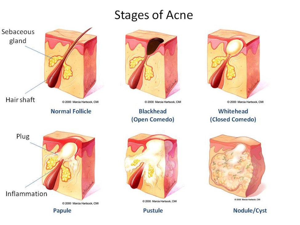 acne-stages