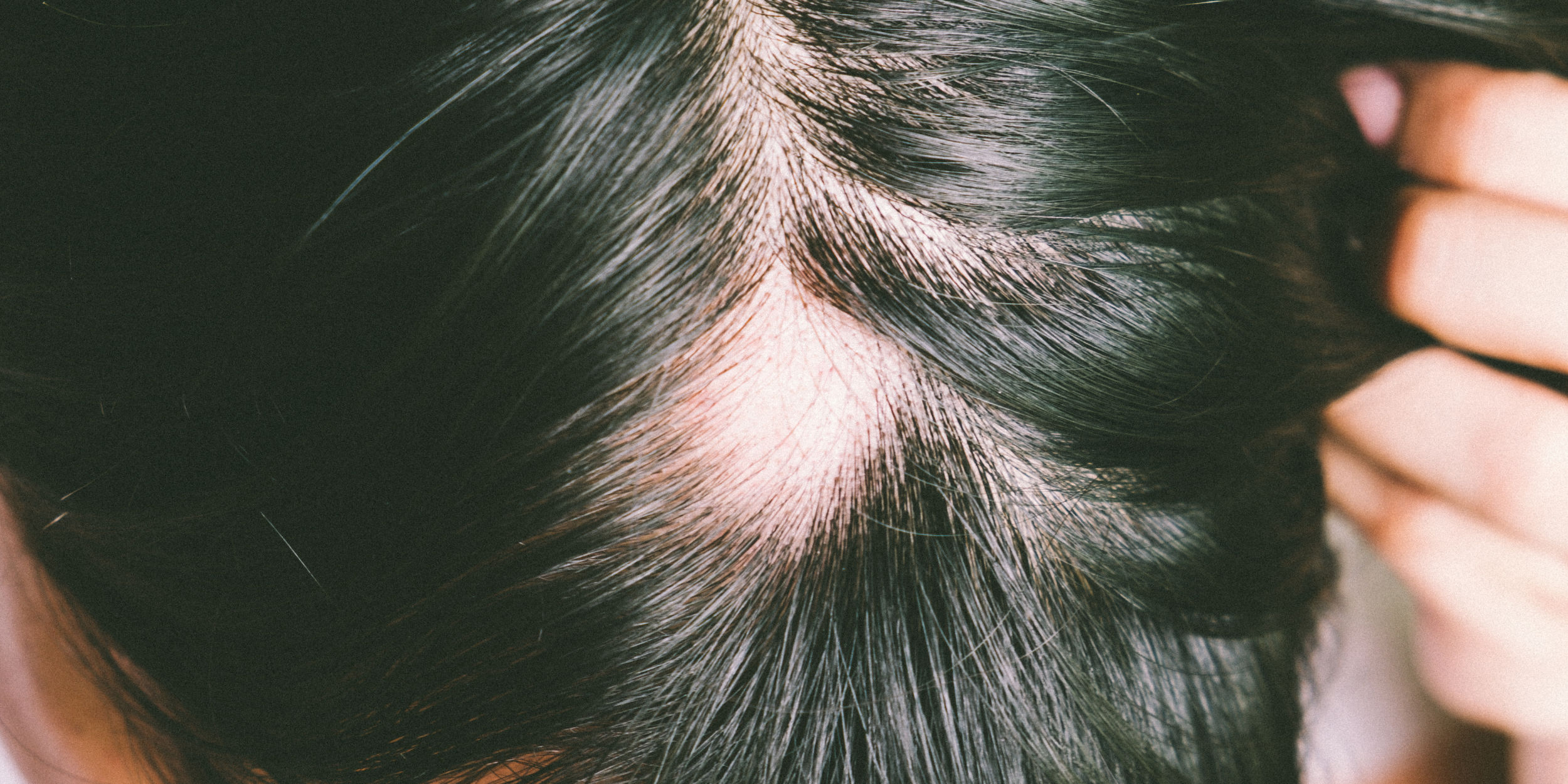 Hair Loss Thinning