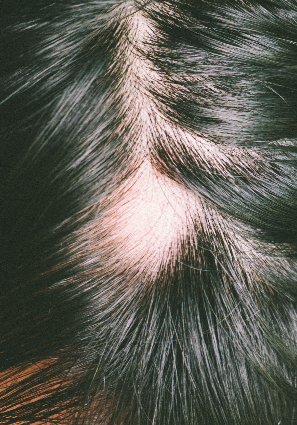 Hair Loss Thinning