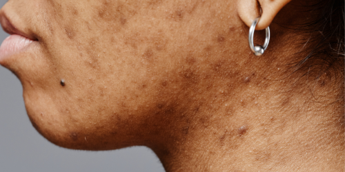 Post-Inflammatory Pigment