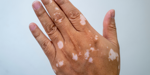 Vitiligo Hand